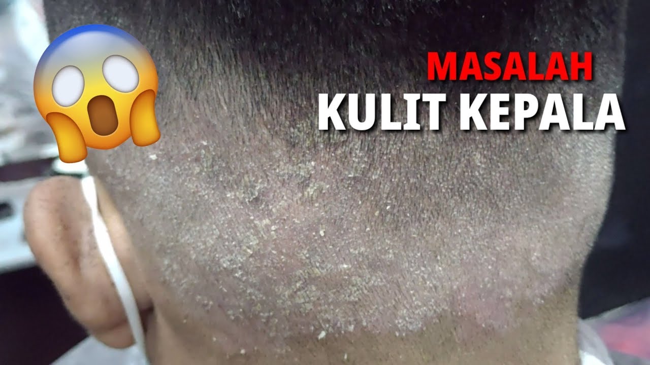 MASALAH KULIT KEPALA / KELEMUMUR || KULIT KERING || SOP KEDAI GUNTING RAMBUT