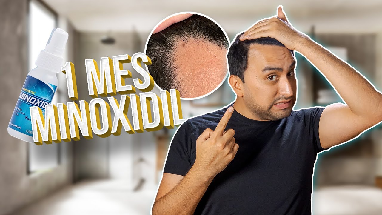 Resultados Del Primer Mes Usando Minoxidil Para La Calvicie