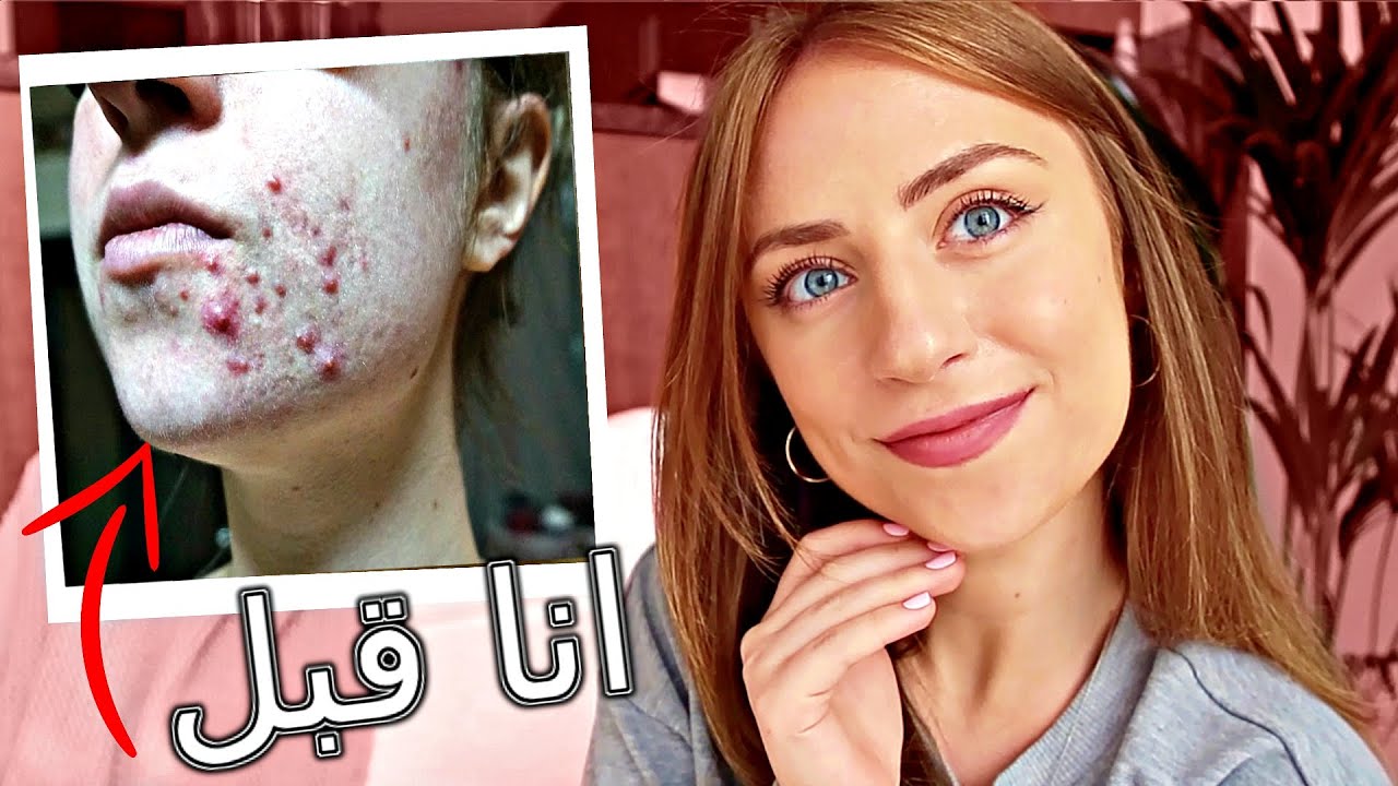 كيف تخلصت من حب الشباب؟ // اخيرا لقيت الحل 🙌 ليلى مراد