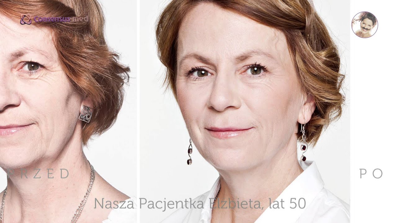 Consensus med - SCULPTRA kwas polimlekowy na trwałe odmłodzenie skóry