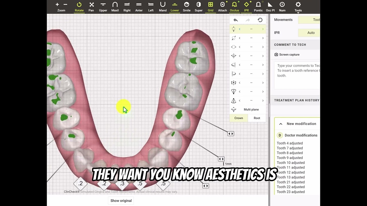 Correcting Crowding, Attrition, Occlusion, Black Triangles with Invisalign Clincheck