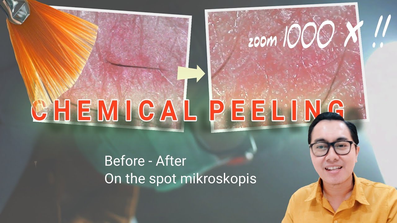Zoom 1000x Pasca Peeling, Pantes Aja Glowing! | Before-After Chemical Peeling dr. Irfan Prasetya