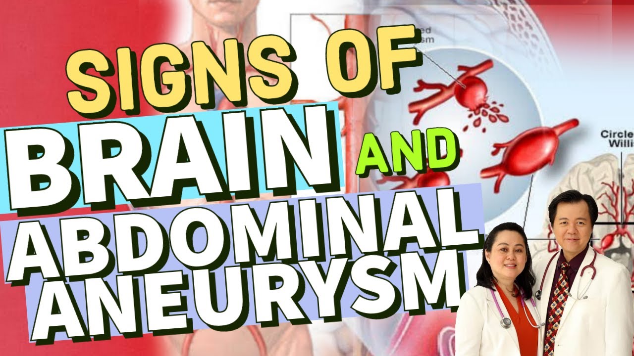 Signs of Brain Aneurysm and Abdominal Aneurysm - Payo ni Doc Willie Ong (Internist and Cardiologist)