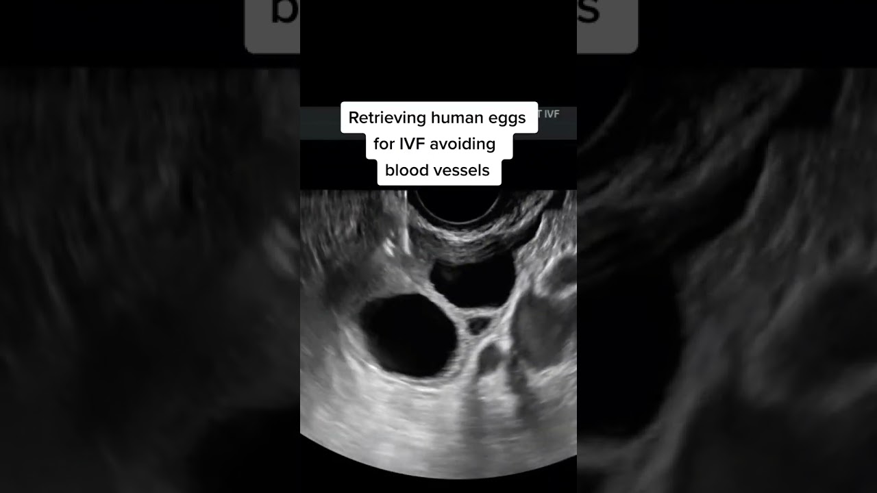 We can extract eggs from a woman's ovaries with no incisions for IVF.