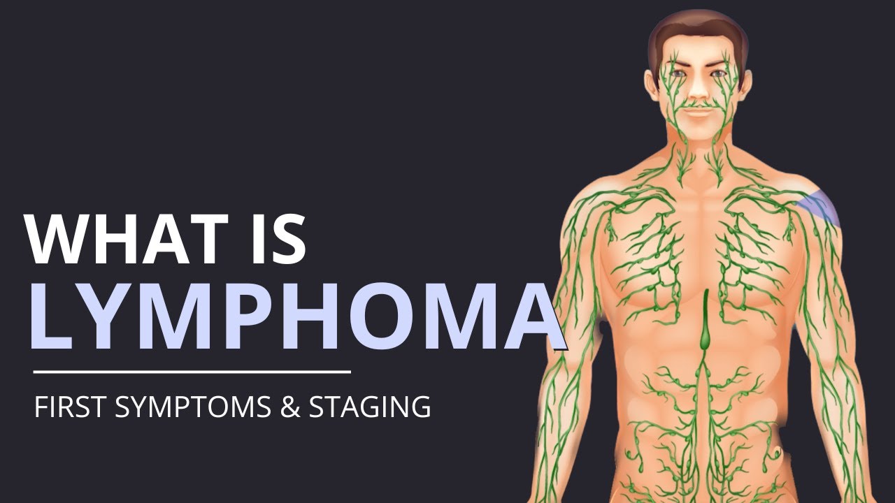 What is Lymphoma? First SYMPTOMS and How It's STAGED! | The Patient Story
