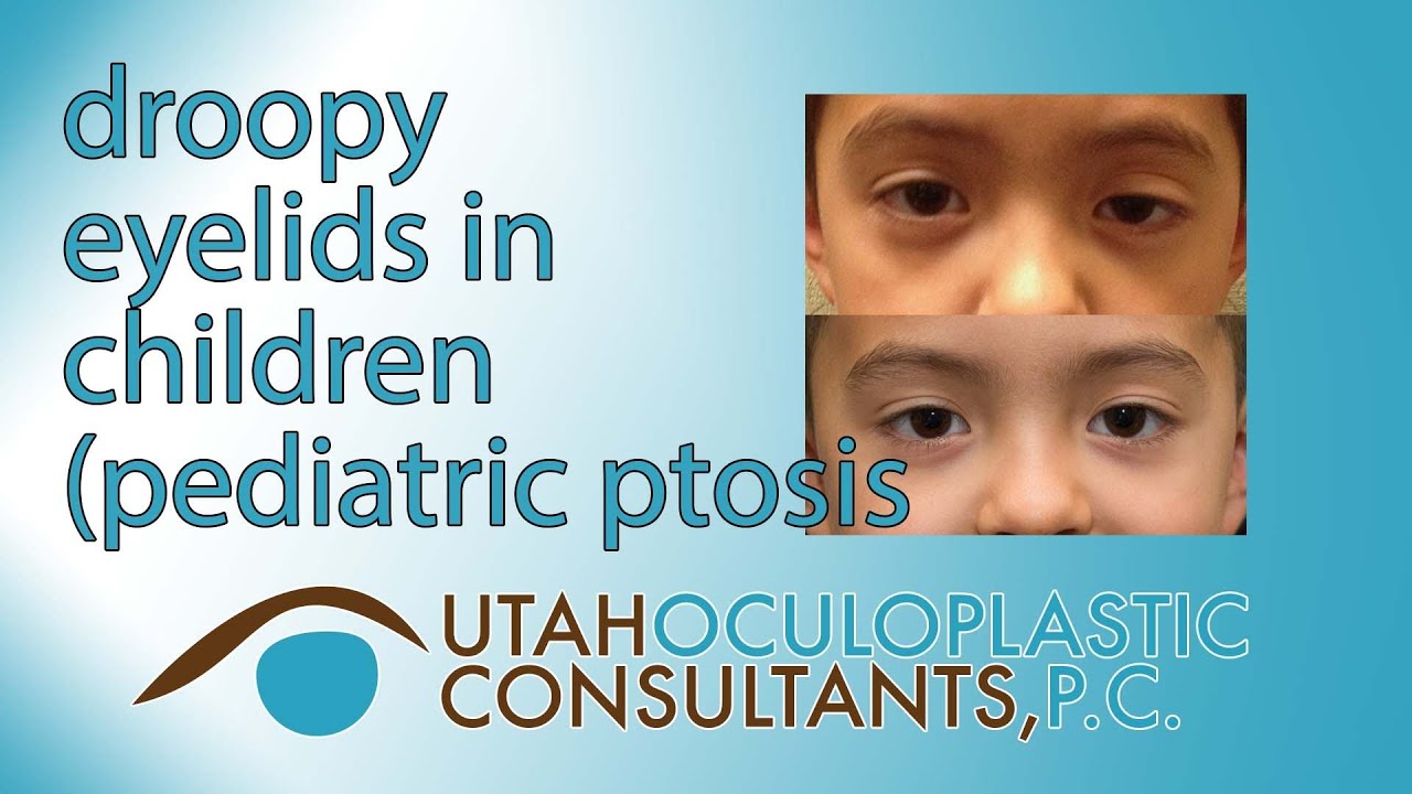 Droopy eyelids in children (pediatric ptosis)
