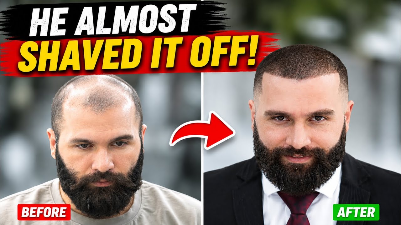 Finally, I Won't Look Bald In Public Anymore! 2023