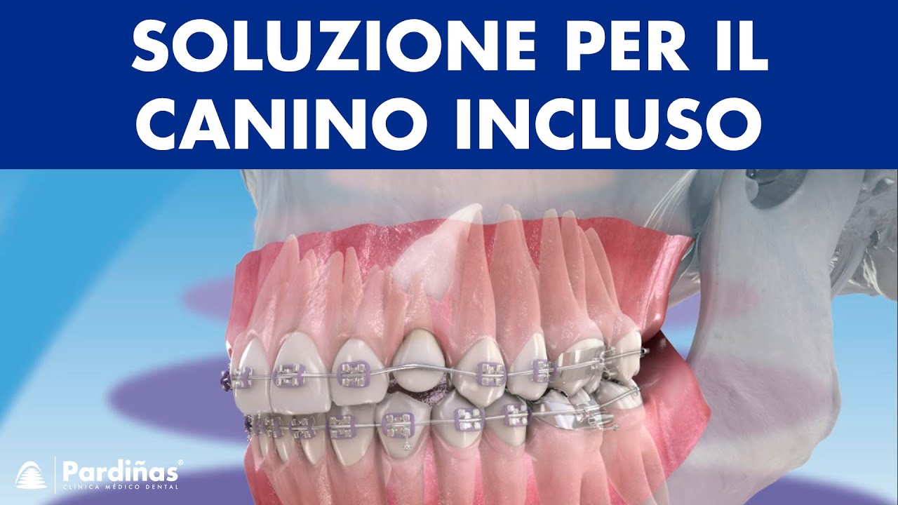 CANINO INCLUSO - Soluzione per denti permanenti che non escono ©