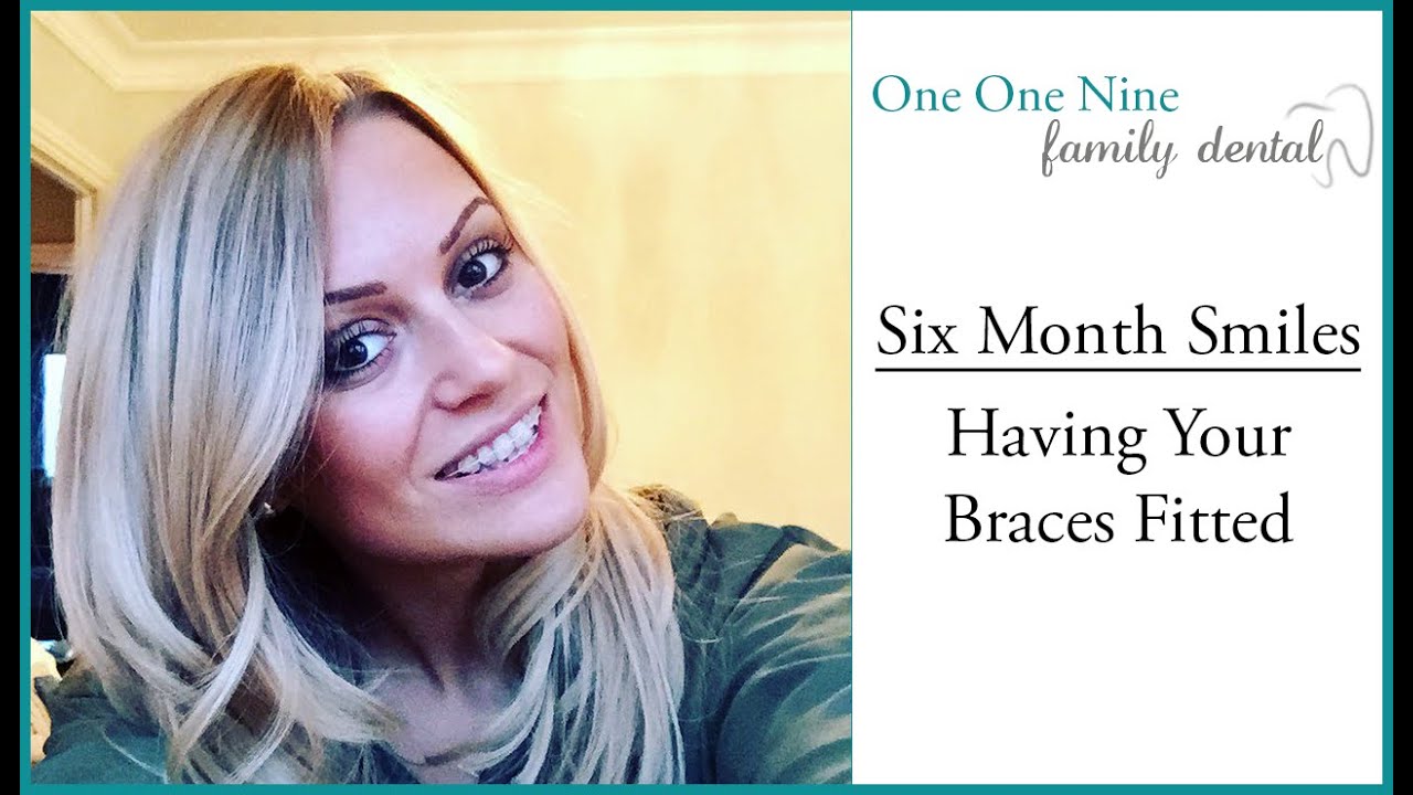 Having Your Six Month Smiles Braces Fitted