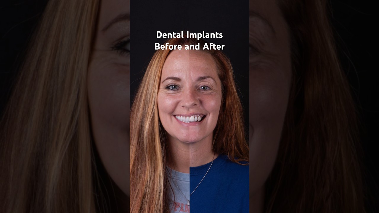 Life Changing All-on-4 Dental Implants | All-on-X Before and After