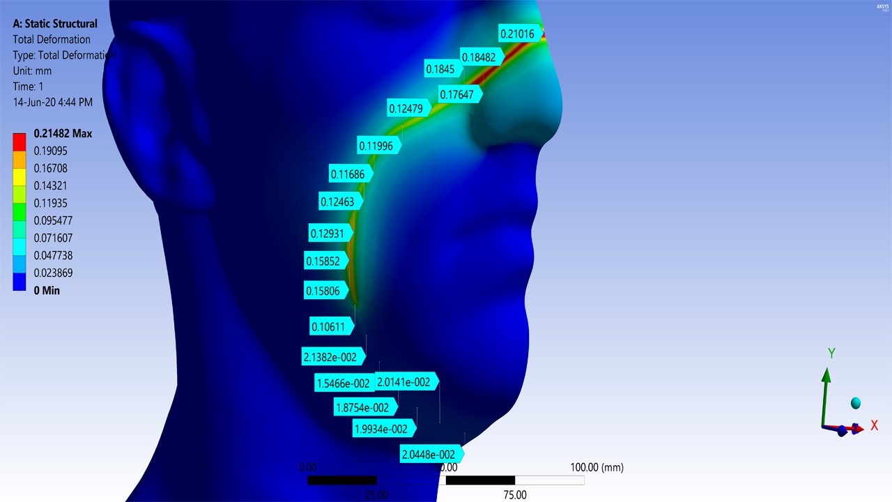 ✅💯✅ Ansys Structural Project # 4 : FEM Analysis of Deformation on Face by Corona Mask
