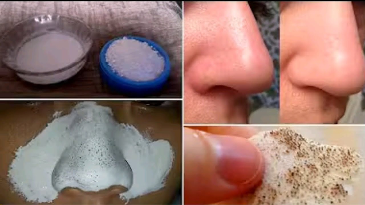 How to Remove Blackheads Naturally