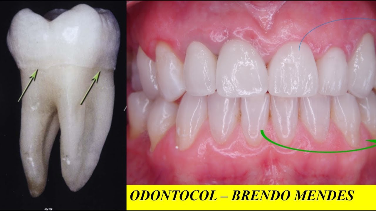 ANATOMIA DENTAL: FACES DOS DENTES E COROA CLÍNICA E ANATÔMICA