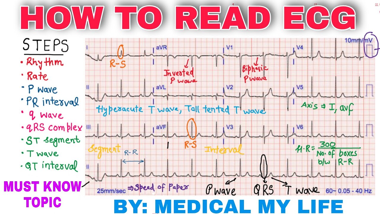 How To Read An ECG