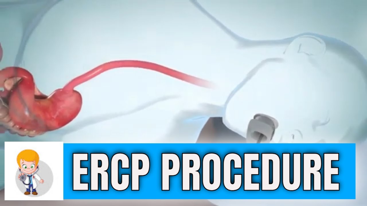 ЭРХПГ (эндоскопическая ретроградная холангиопанкреатография): процедура в 3D