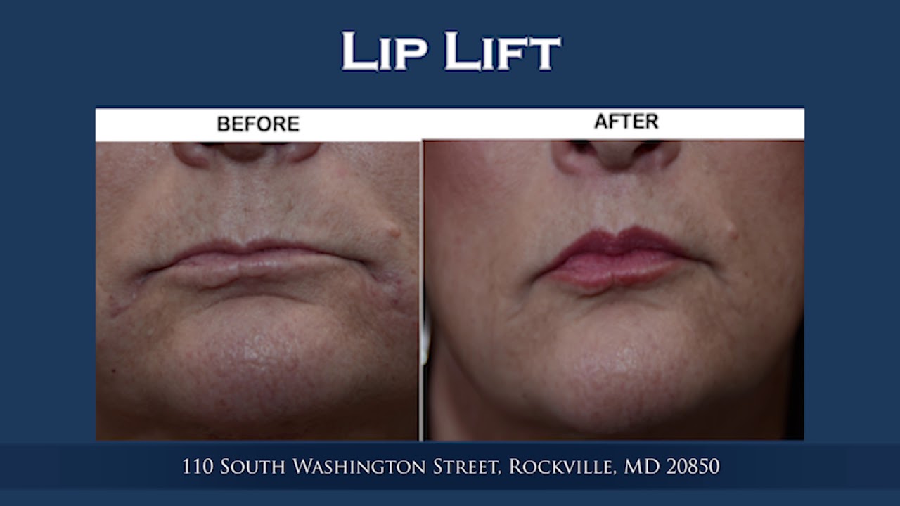 Lip Lift vs. Lip Filler