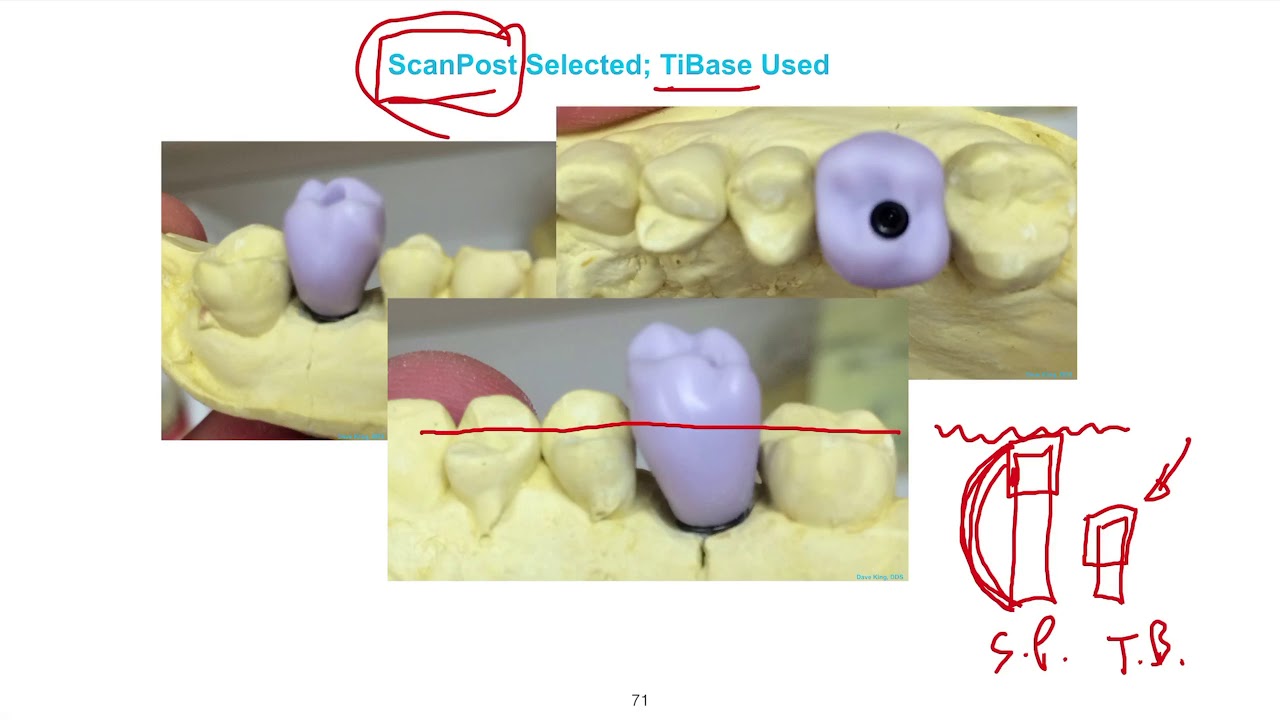 Серия лекций CEREC TiBase, Урок 05