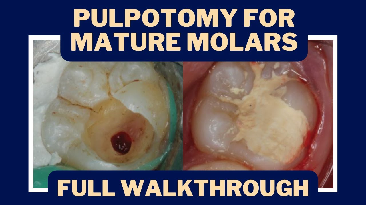 Pulpotomies for Irreversible Pulpitis? The Rise of Vital Pulp Therapy - PDP133