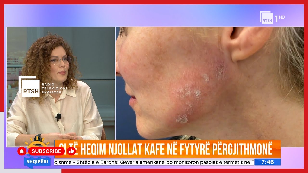 A mund të hiqen përgjithmonë njollat kafe në fytyrë? S'do ta besoni çfarë thotë dermatologia