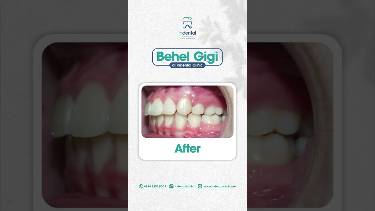 Percayakan perawatan behel gigi hanya pada dokter gigi spesialis ortodonti. #behelgigi #doktergigi