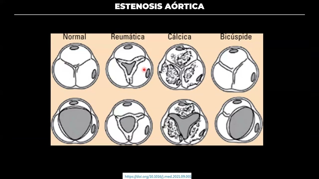 ESTENOSIS AÓRTICA: Conceptos esenciales