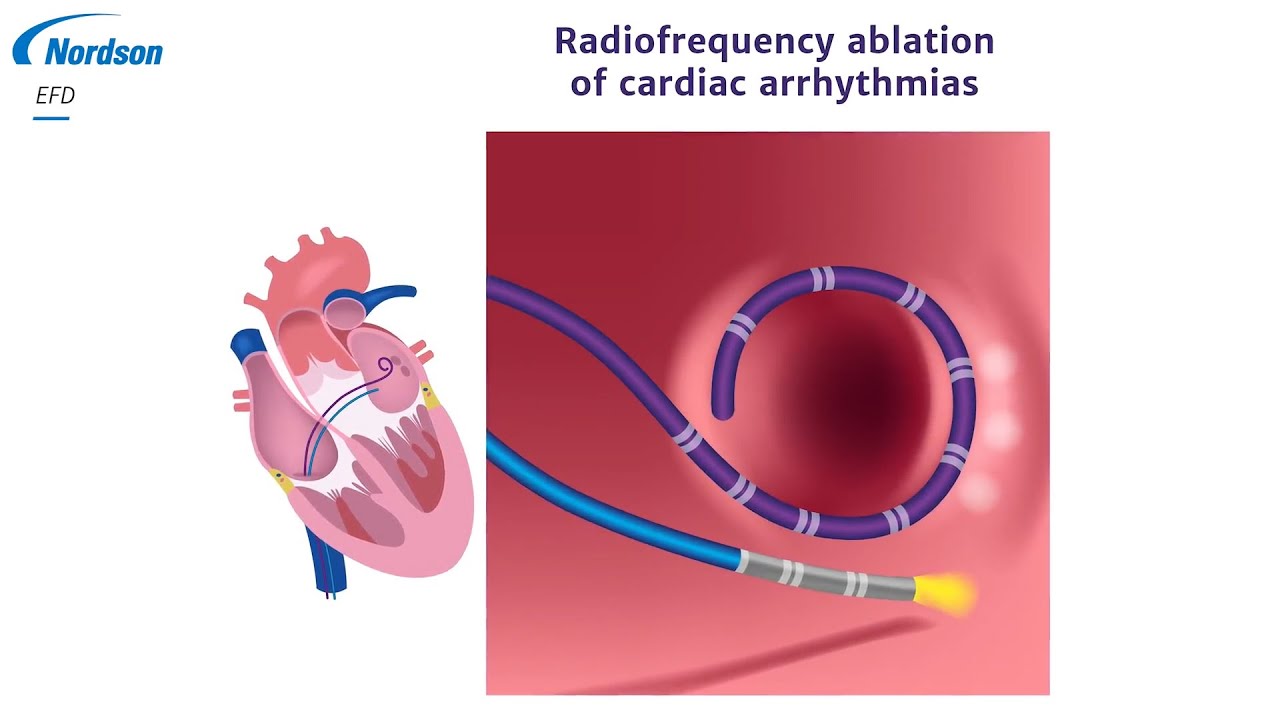 MedTech: Race to the Micro – Ablation Catheters – Episode 3