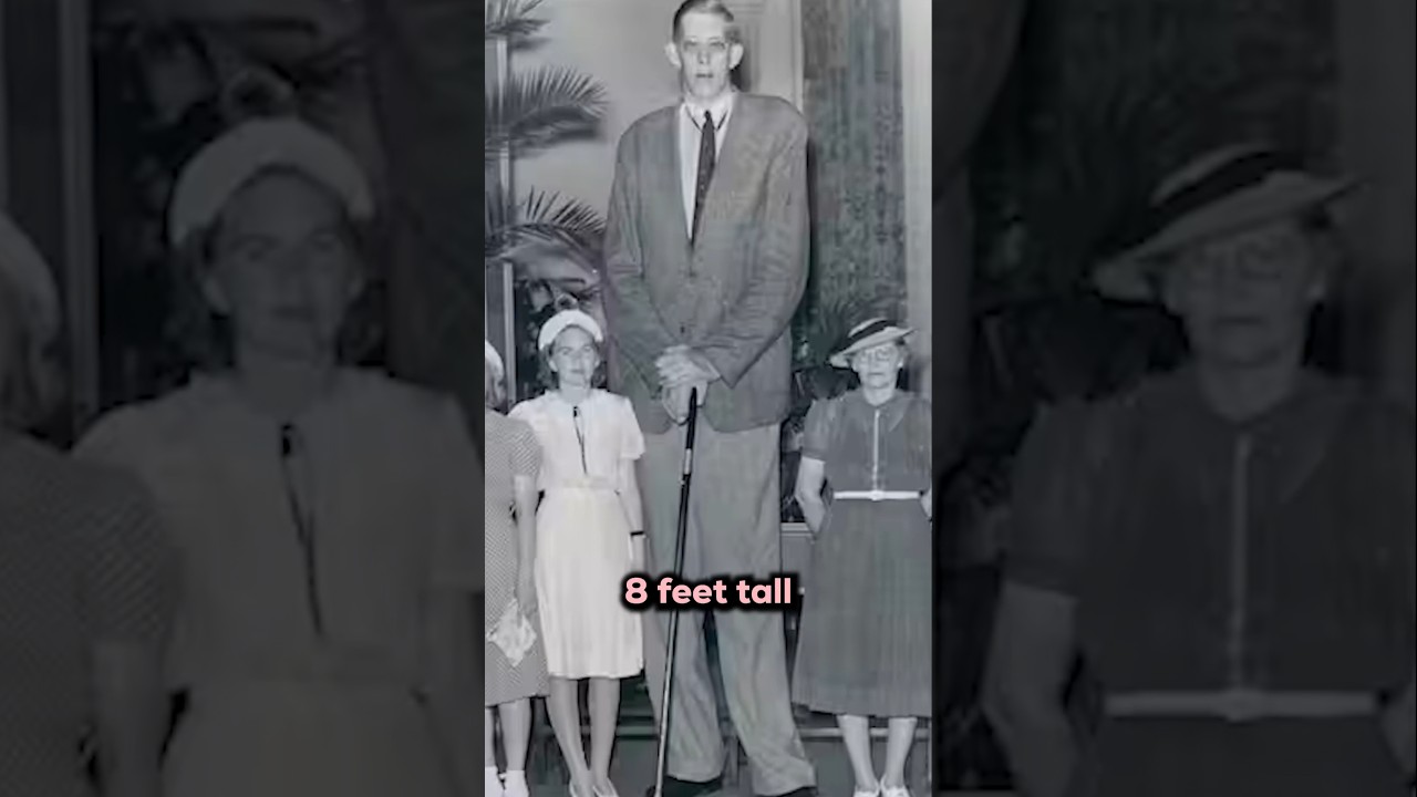 8 Feet Tall! Too Much Growth Hormone!