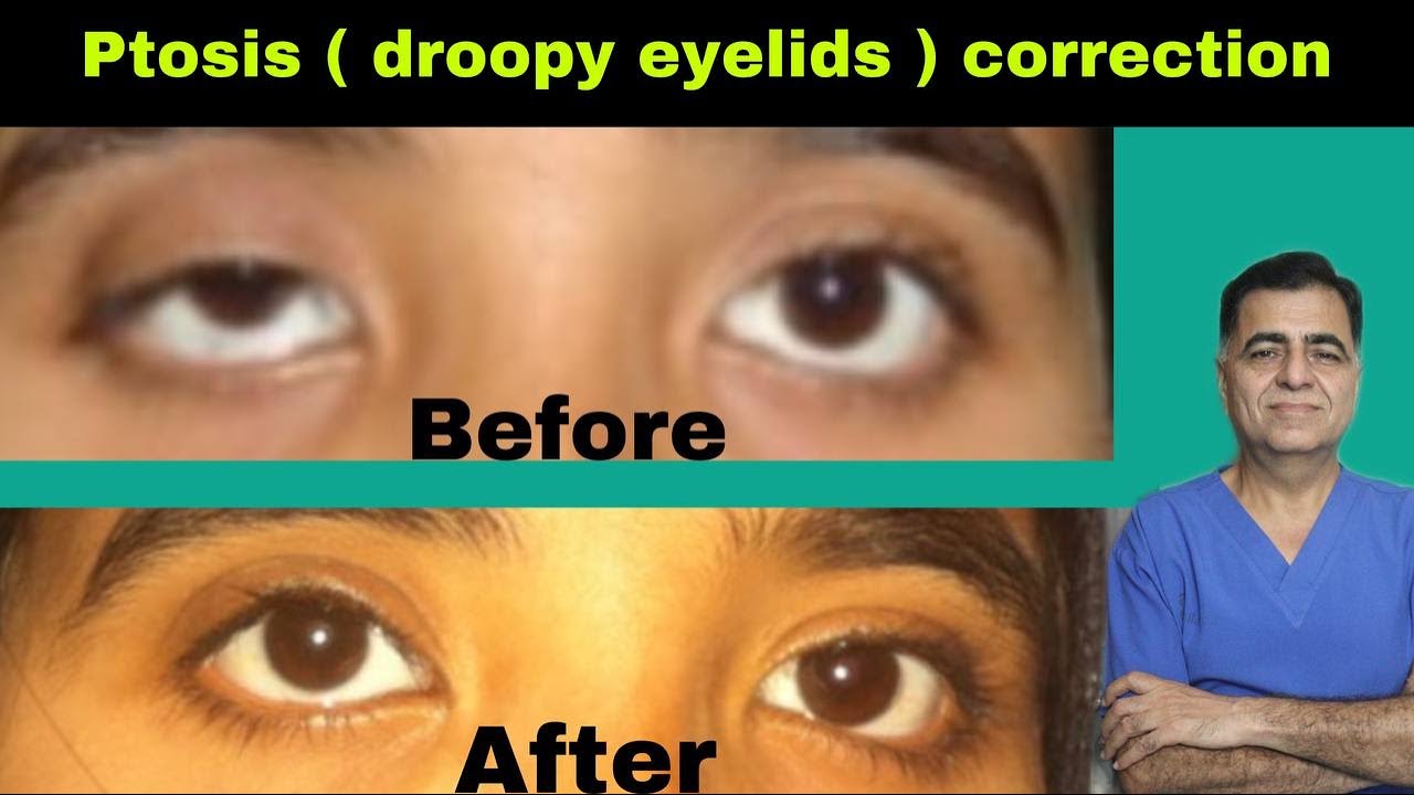 Droopy upperlid (Ptosis) surgery in Kanpur || Dr.S.K. Gulati