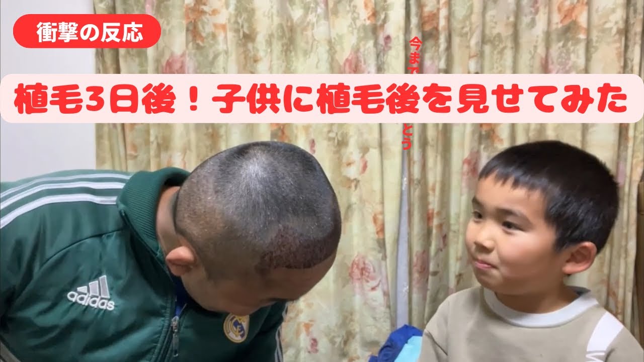植毛後3日目｜帰国後、子供たちのリアクションが想像以上だった…