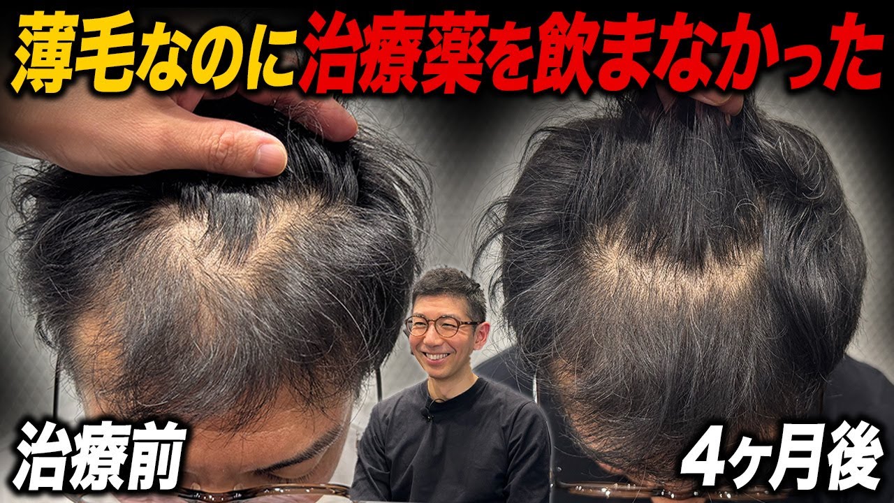 【薄毛を放置した43歳】治療開始から4ヶ月の現実
