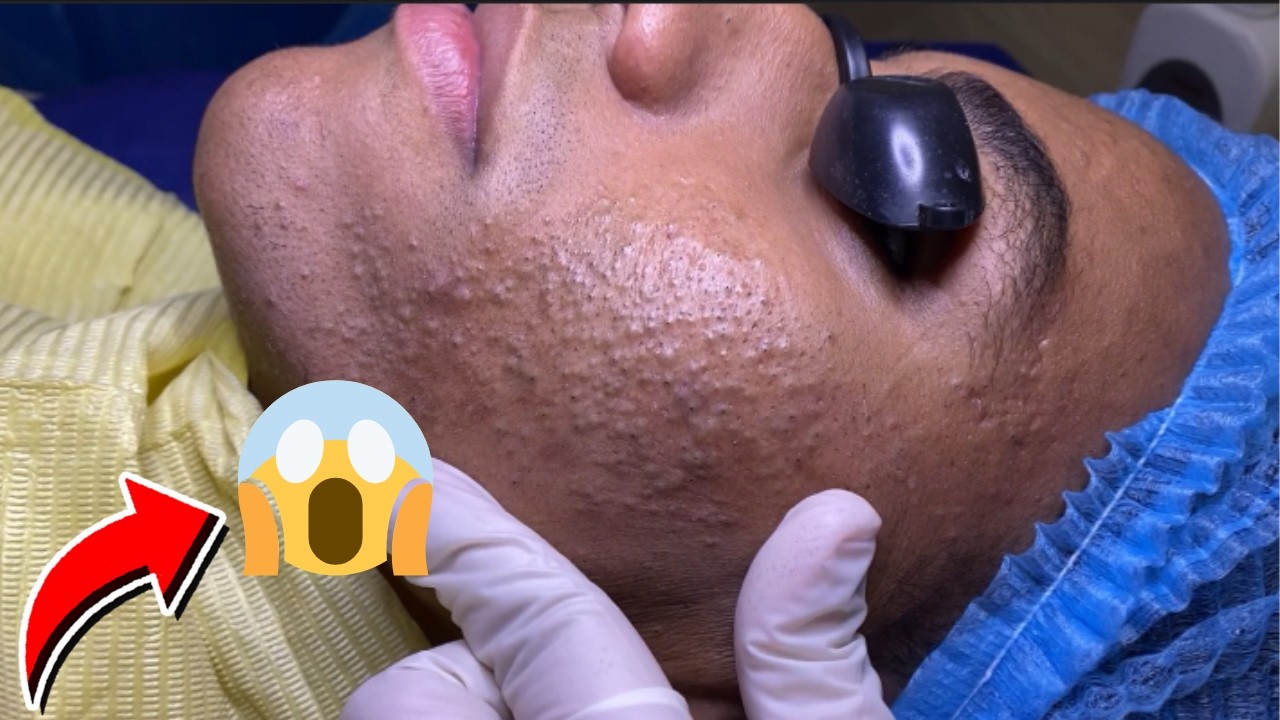 EXTRA&Ccedil;&Atilde;O DE CRAVOS SATISFAT&Oacute;RIA | LIMPEZA DE PELE COMENTADA POR ESTETICISTA! #356422