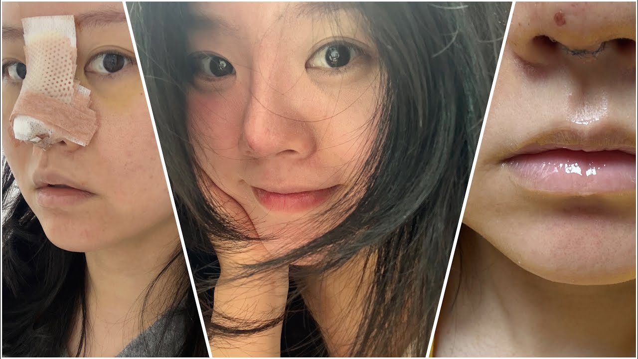 브이로그 : 못생김 최대인 일주일 기록🥹 코실리콘 전체제거 코 보형물 제거 후기 (통증 + 수술후기 + 회복기간) 나 내코 좋았는데 ..  안녕😭