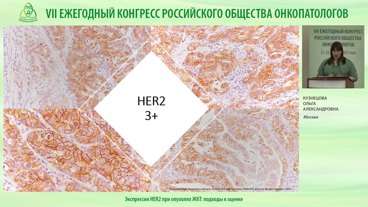 Экспрессия HER2 при опухолях ЖКТ – подходы к оценке