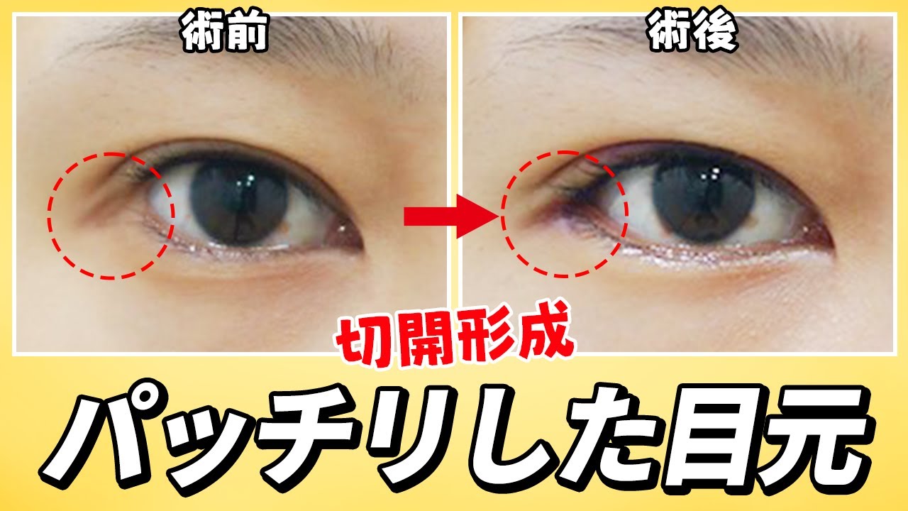 【韓国整形】目もとをアップグレード!! 目頭から目尻まで、切開で大変身!!