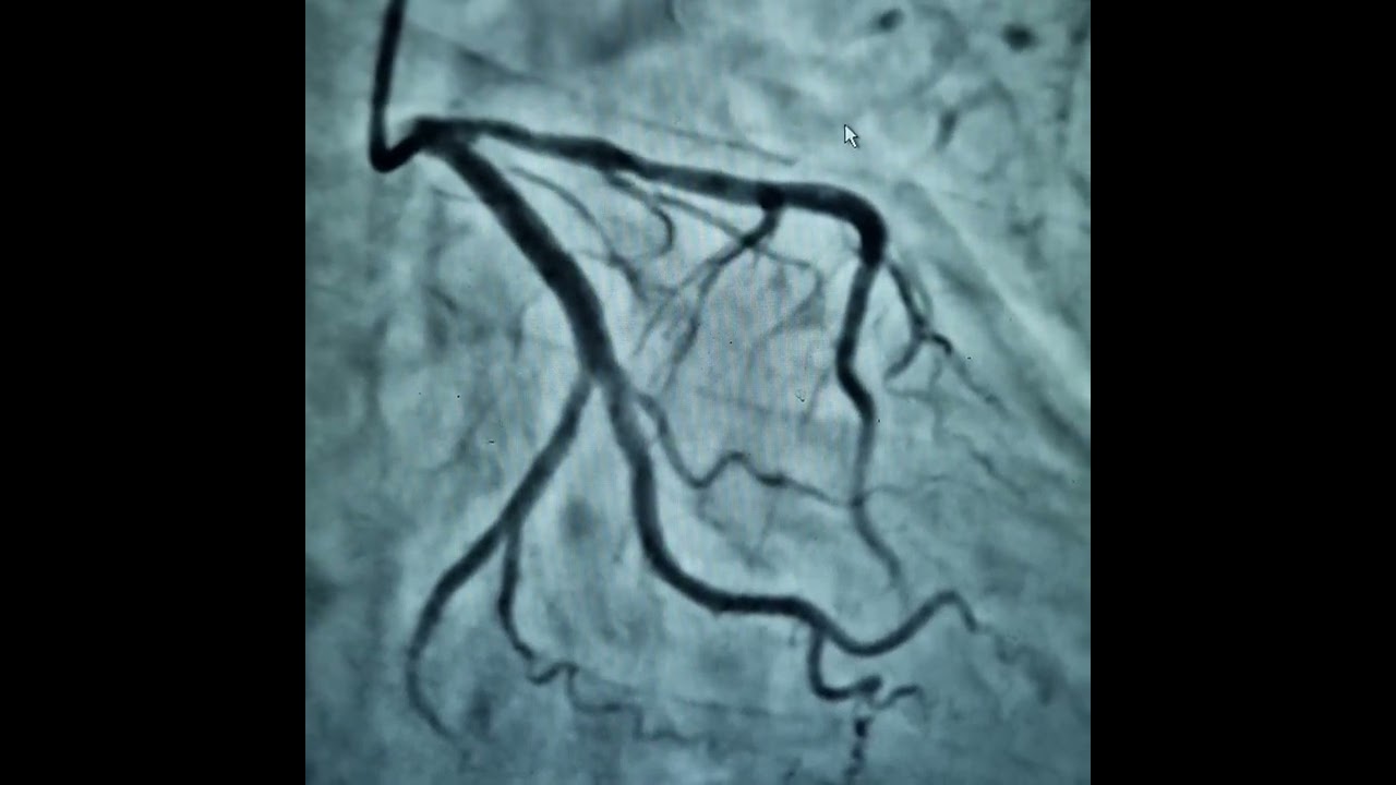 PTCA + Stenting to Ostial LAD (NSTEMI) | Best Cardiologist in Agra | Dr. Rajat Rawat