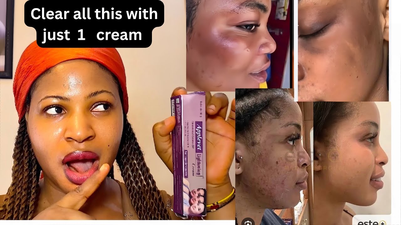 Cheapest product that treat eczema acne rough face hyperpigmentation sunburn and redness in few days