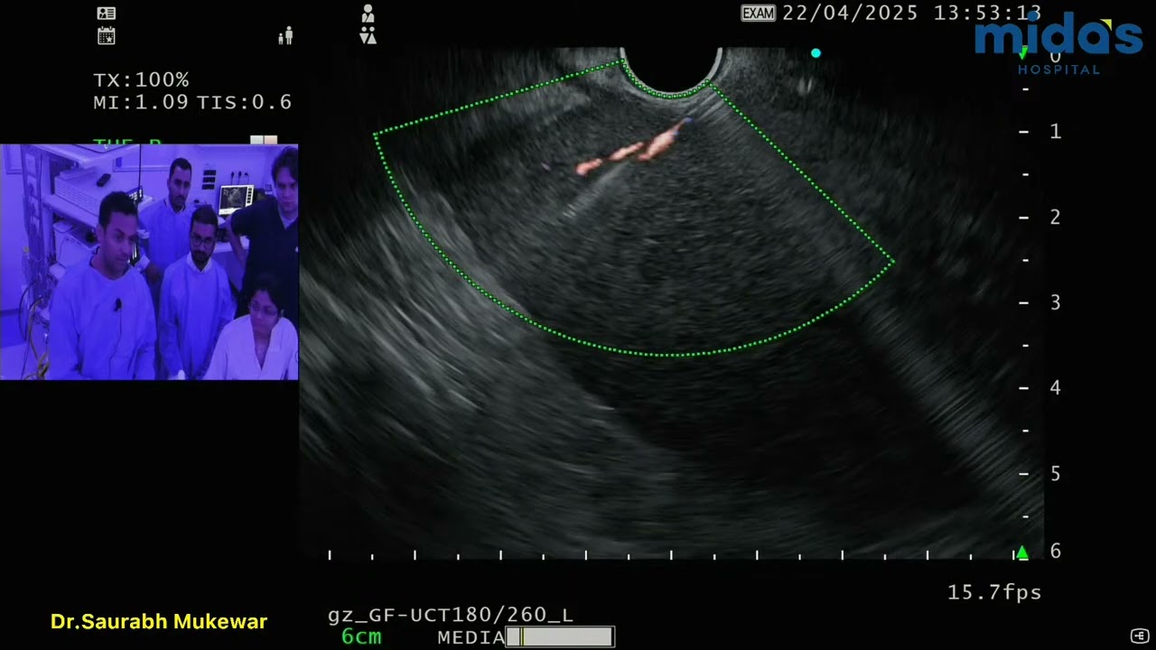 Live EUS-Guided Liver Biopsy (unedited) performed by Dr. Saurabh Mukewar