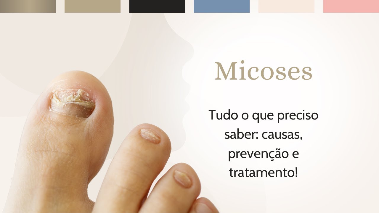 MICOSES: CAUSAS, PREVENÇÃO E TRATAMENTO