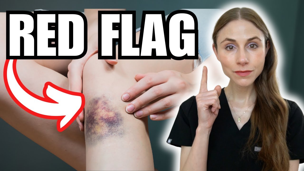 Bruising Easily? Here Are the Red Flags