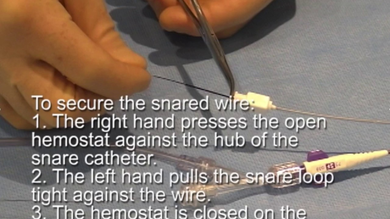 Orthodromic Snare Technique 