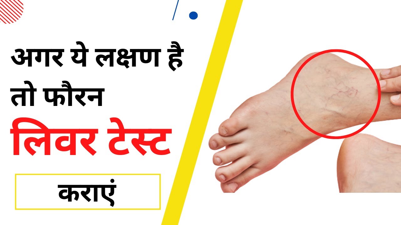 लिवर खराब होने के 3 सबसे बड़े लक्षण  | liver kharab hone ke lakshan | SELF DOCTOR