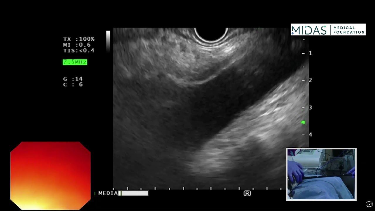 EUS examination of mediastinum (Subcarinal space)