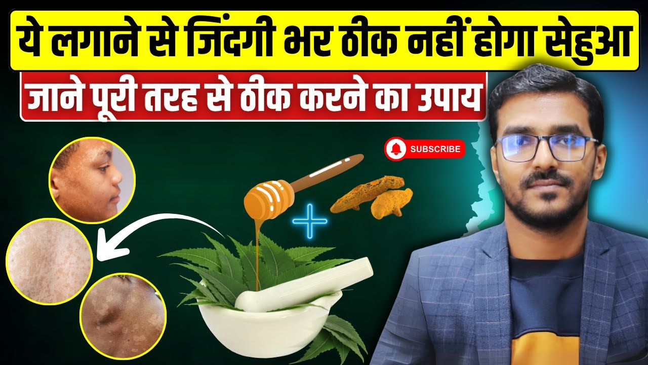 सेहुआ क्यों होते है और इलाज क्या है | Sehua Homeopathic Medicine | Tinea Versicolor Treatment