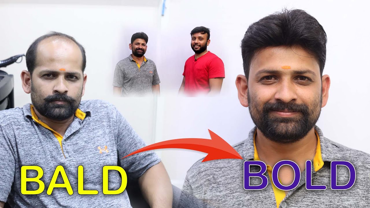 Hair fixing for men in Bangalore | Basic (Low price) Hair patch video | Call- 9110221804/ 9742549827