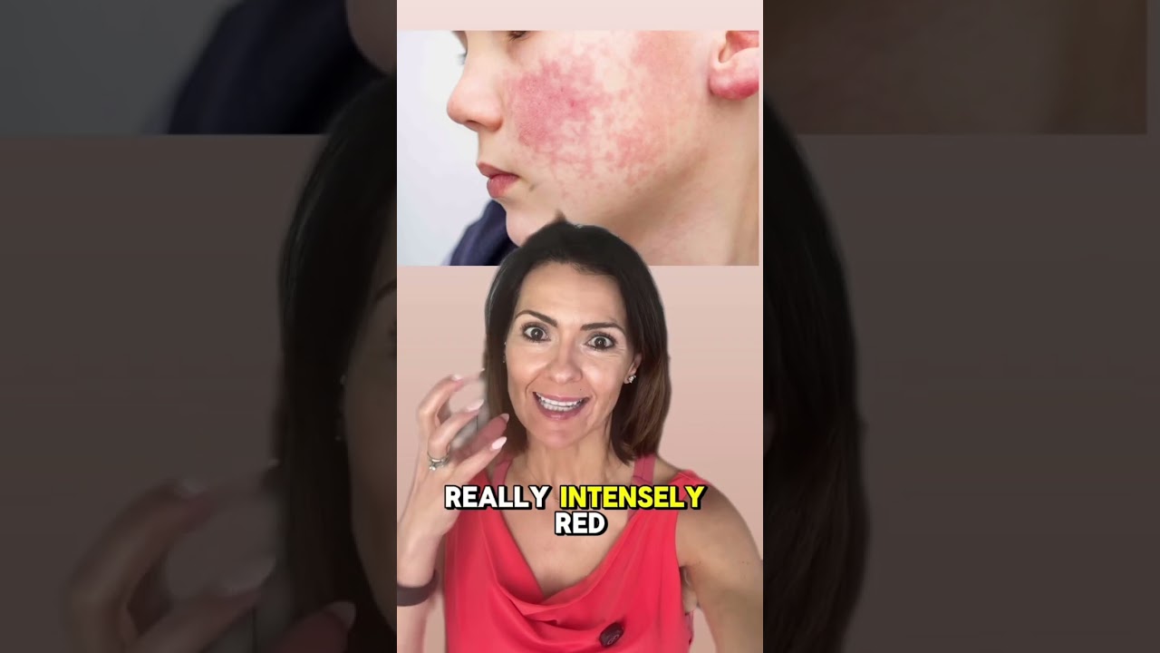 Fifths Disease #pediatriciantips #holisticpediatrician #holistichealthtips #pediatricadvice