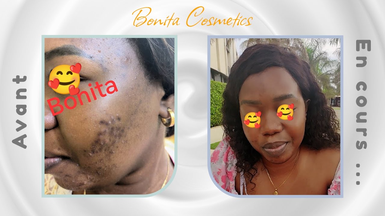 Traitement acné inflammatoire