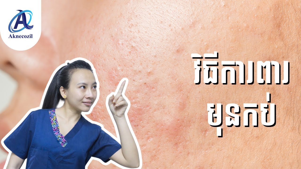 វិធីការពារមុនកប់