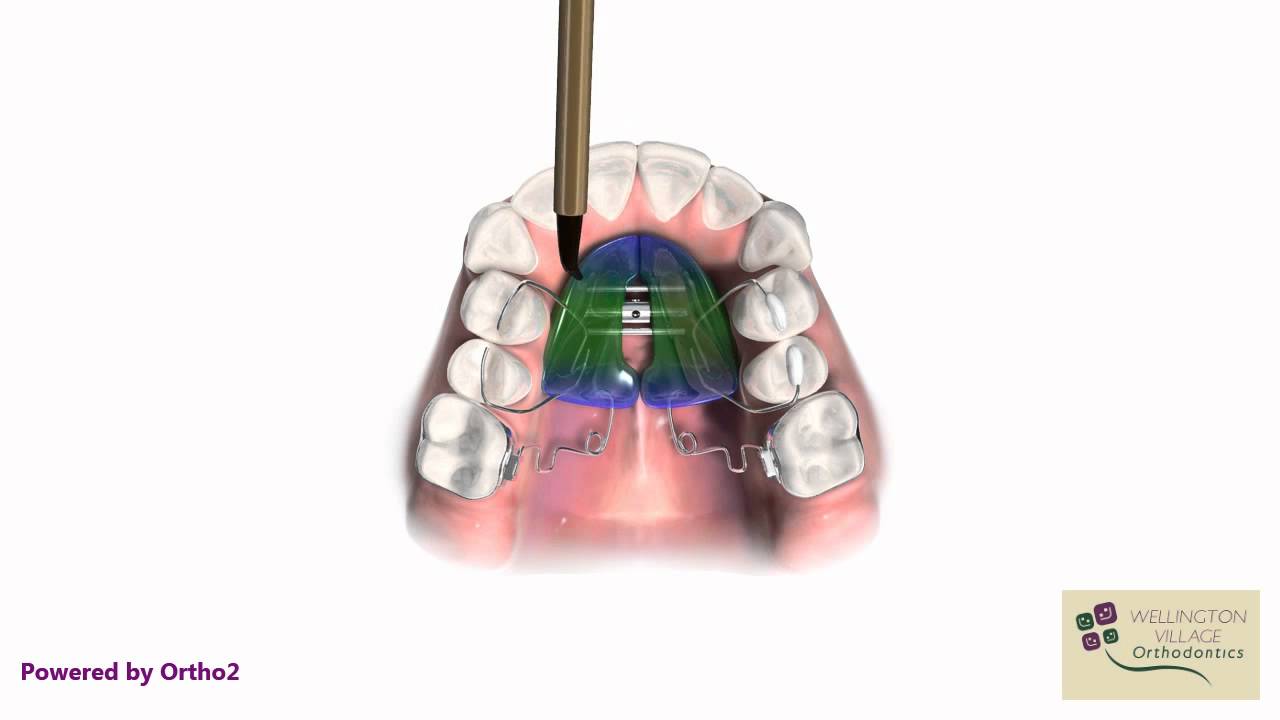 Pendulum Appliance - Wellington Village Orthodontics