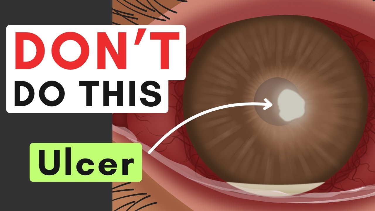 Corneal Ulcers: 5 Mistakes That Can WORSEN Vision Fast