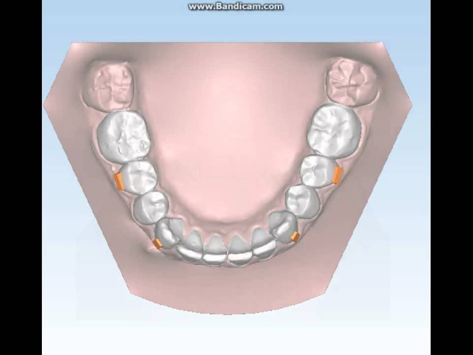 Ortodonzia Invisibile Aurodental 20